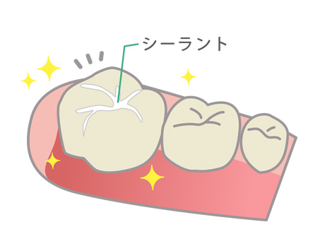 シーラント